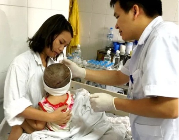 Ca nối da đầu cho bé gái nhỏ tuổi nhất thế giới thành công ngoạn mục tại BV Việt Đức