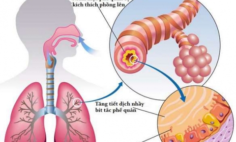 Dấu hiệu viêm phế quản phổi